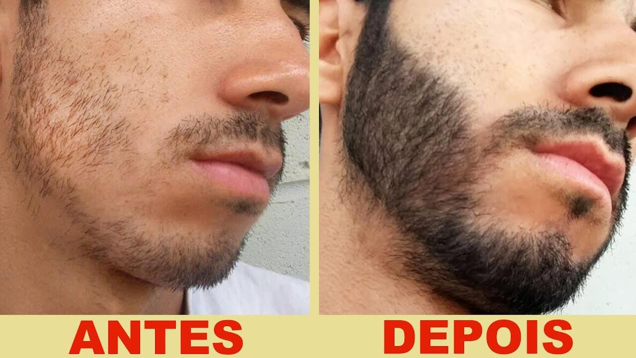 Minoxidil Funciona